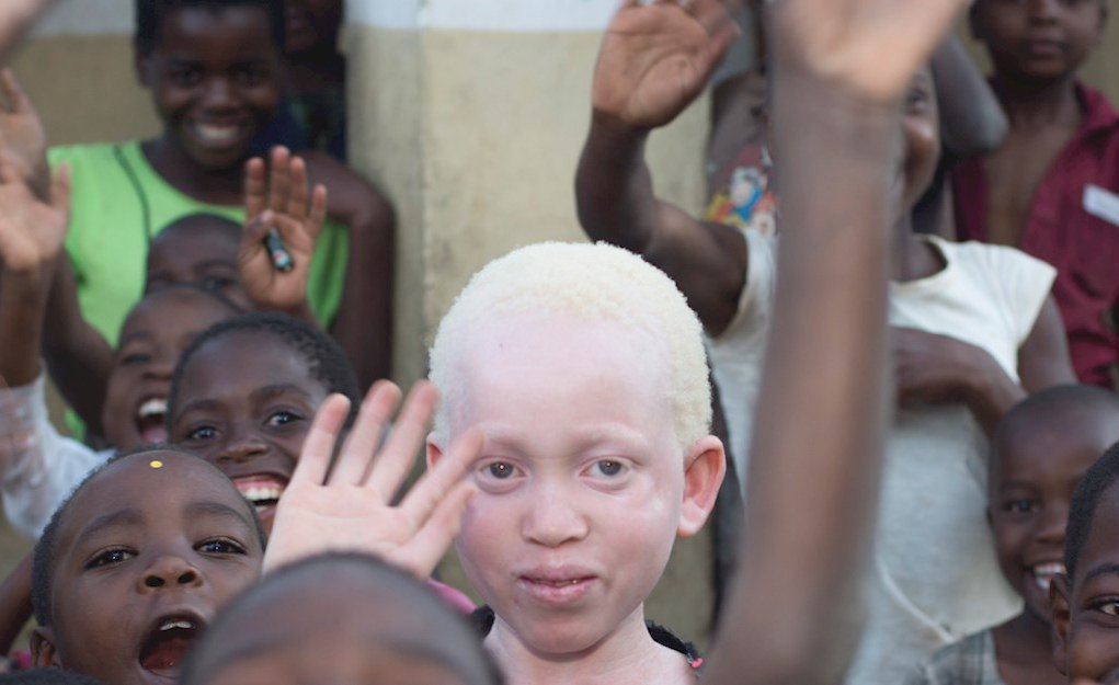 People with Albinism strengthen their campaign for protection